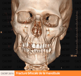Traumatologie faciale : les fractures de la mandibule